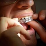 Allineatori trasparenti per ortodonzia invisibile nello studio dentistico a Genzano di Roma