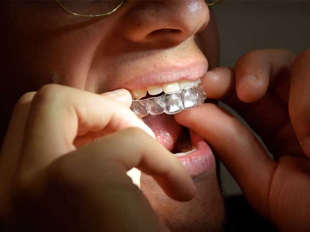 allineatori-trasparenti-ortodonzia-invisibile-studio-rudina-rustemaj-genzano-di-roma.jpg- Allineatori trasparenti per ortodonzia invisibile nello studio dentistico a Genzano di Roma
